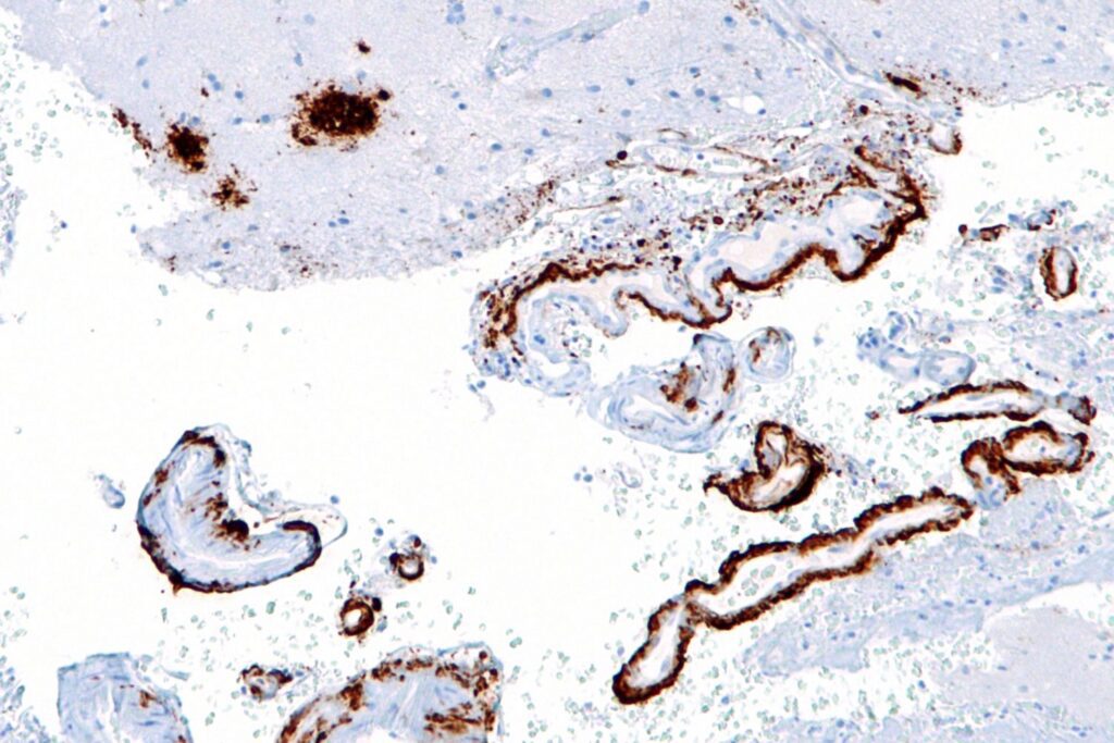 Un test de 3 minutos podría diagnosticar el alzhéimer años antes de que dé la cara