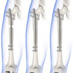 Aumentar tu altura es posible: en España ya hay centros especializados, aunque el método da bastante miedo